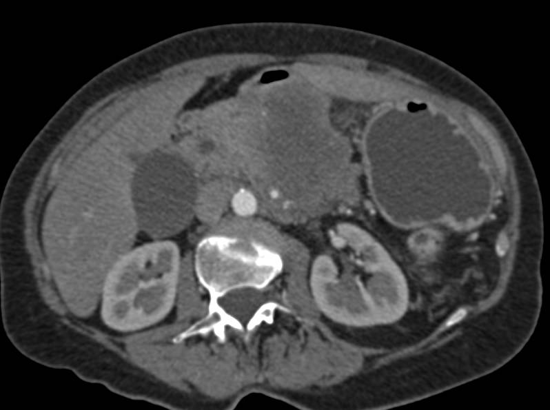 Pancreatic Cancer Invades the Portal Vein and Superior Mesenteric Vein (SMV) - CTisus CT Scan