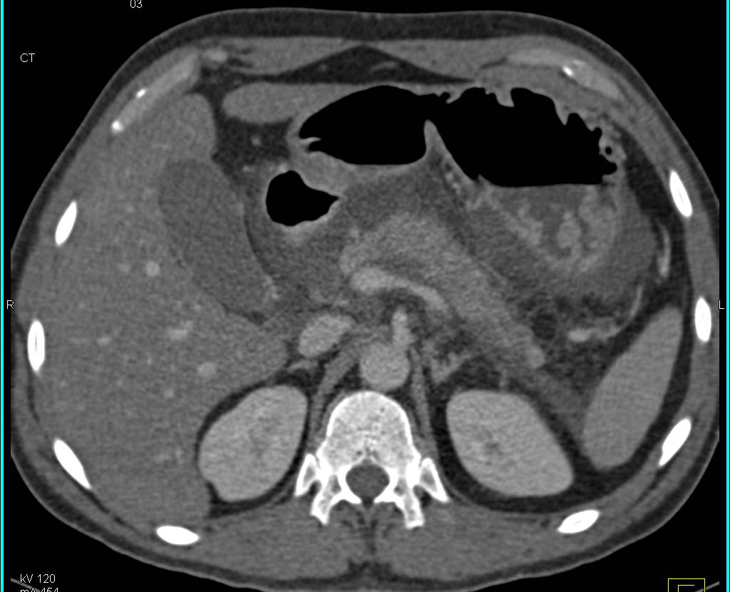 Acute Pancreatitis - CTisus CT Scan