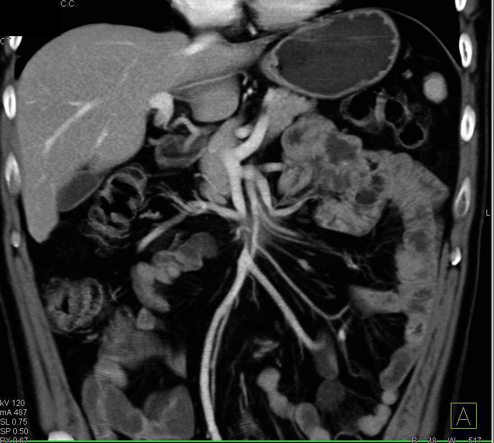 Pancreatic Cancer Involves the Superior Mesenteric Artery (SMA) and Superior Mesenteric Vein (SMV) - CTisus CT Scan