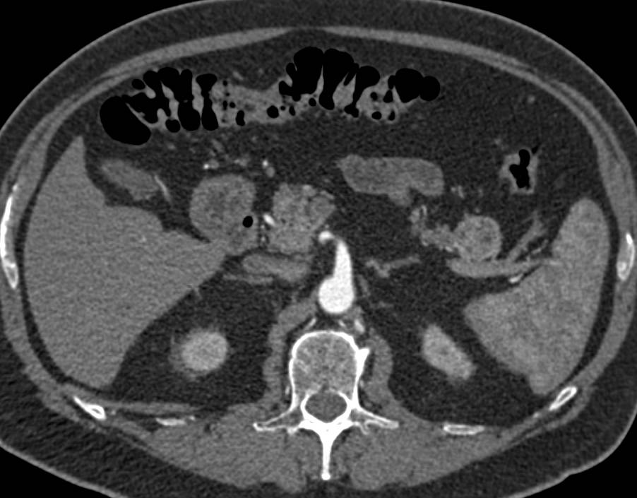 Cystic Neuroendocrine Tumor Tail of Pancreas - CTisus CT Scan