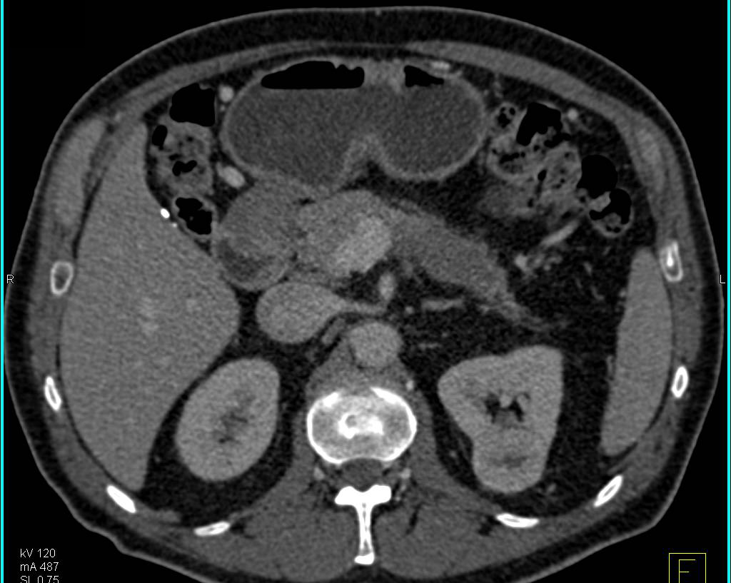 Carcinoma of the Tail of the Pancreas - CTisus CT Scan