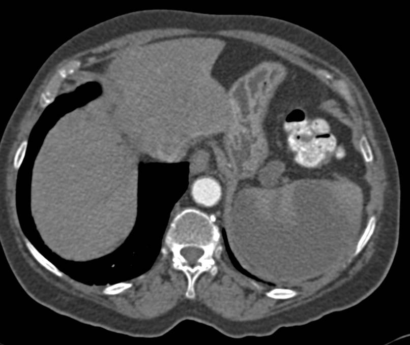 Large Splenic Infarct in a Patient with Chronic Pancreatitis - CTisus CT Scan