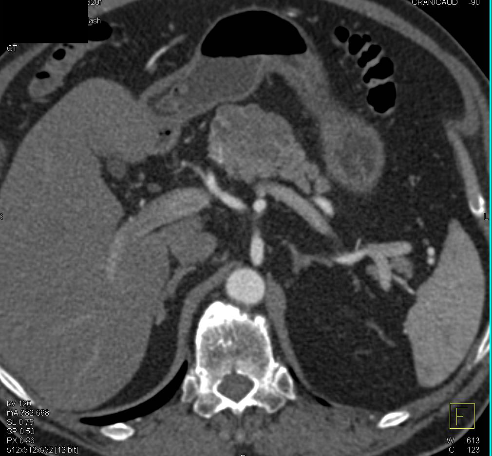 Serous Cystadenoma of the Pancreas - CTisus CT Scan