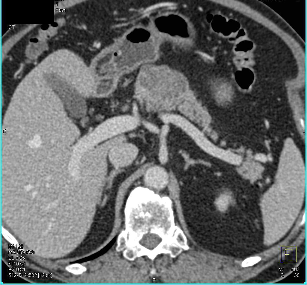 Serous Cystadenoma of the Pancreas - CTisus CT Scan