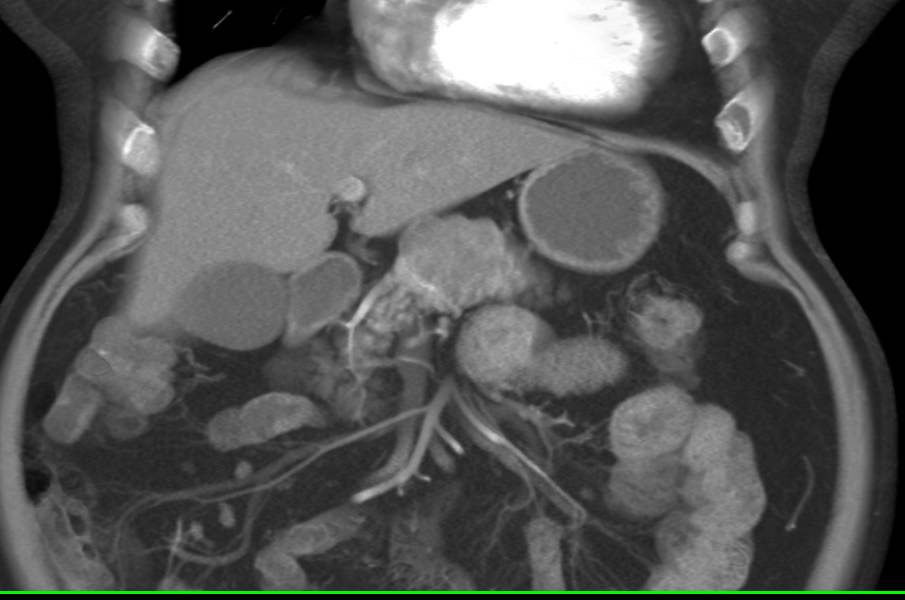 Serous Cystadenoma - CTisus CT Scan