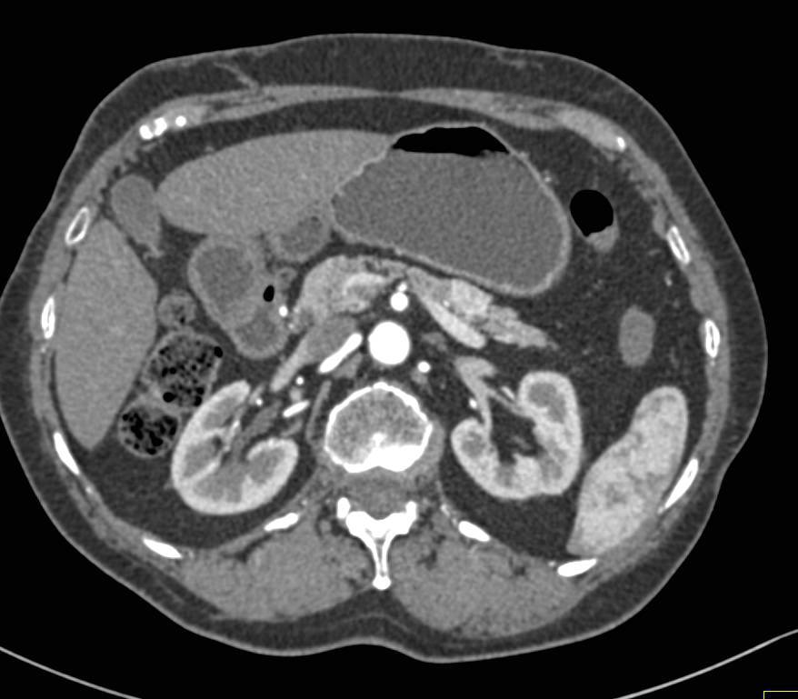 Neuroendocrine Tumor of the Tail of the Pancreas - CTisus CT Scan