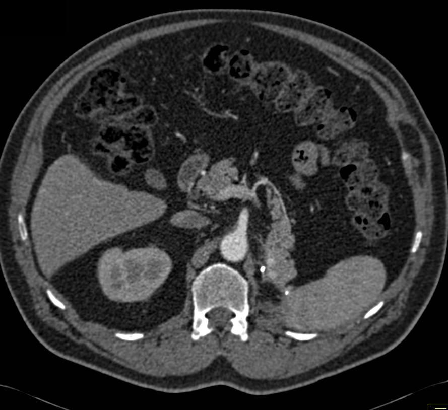 Vascular Metastases to the Tail of the Pancreas in Patient with History of Renal Cell Carcinoma - CTisus CT Scan