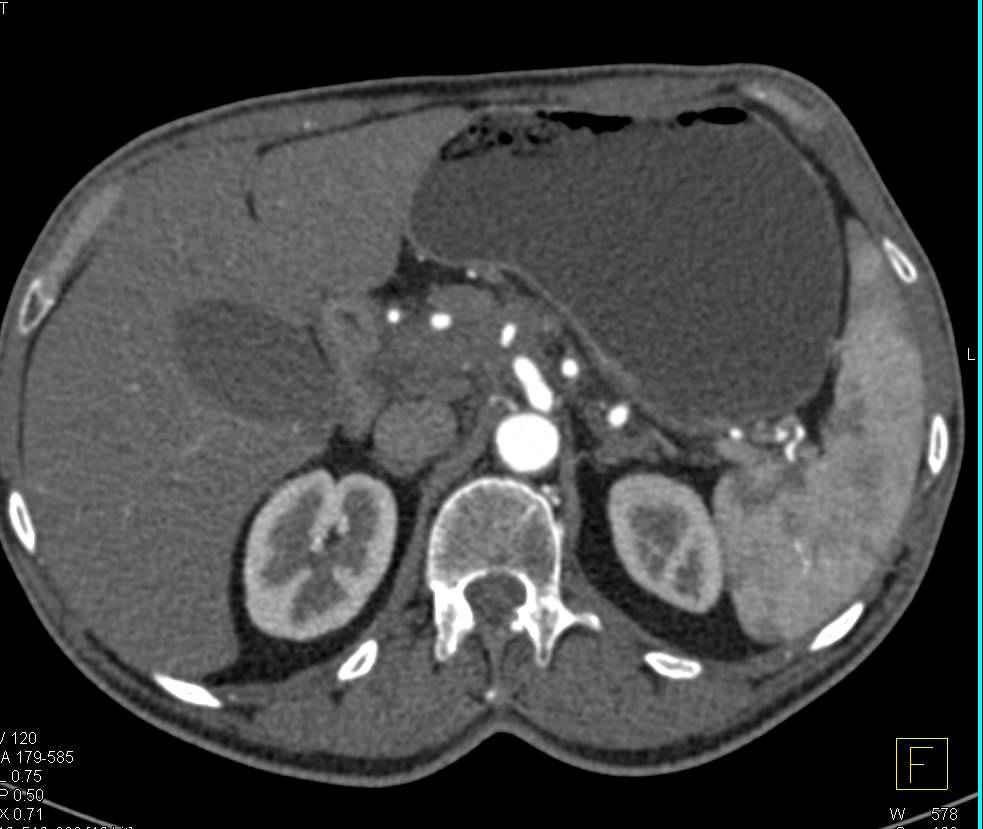 Adenocarcinoma of the Body of the Pancreas and a Neuroendocrine Tumor in the Tail of the Pancreas - CTisus CT Scan