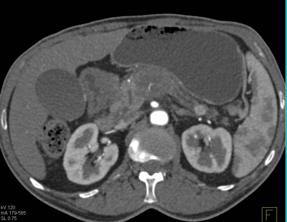 Incredible Case of Carcinoma of the Body of the Pancreas with Pancreatic Neuroendocrine Tumor (PNET) of the Tail of the Pancreas - CTisus CT Scan