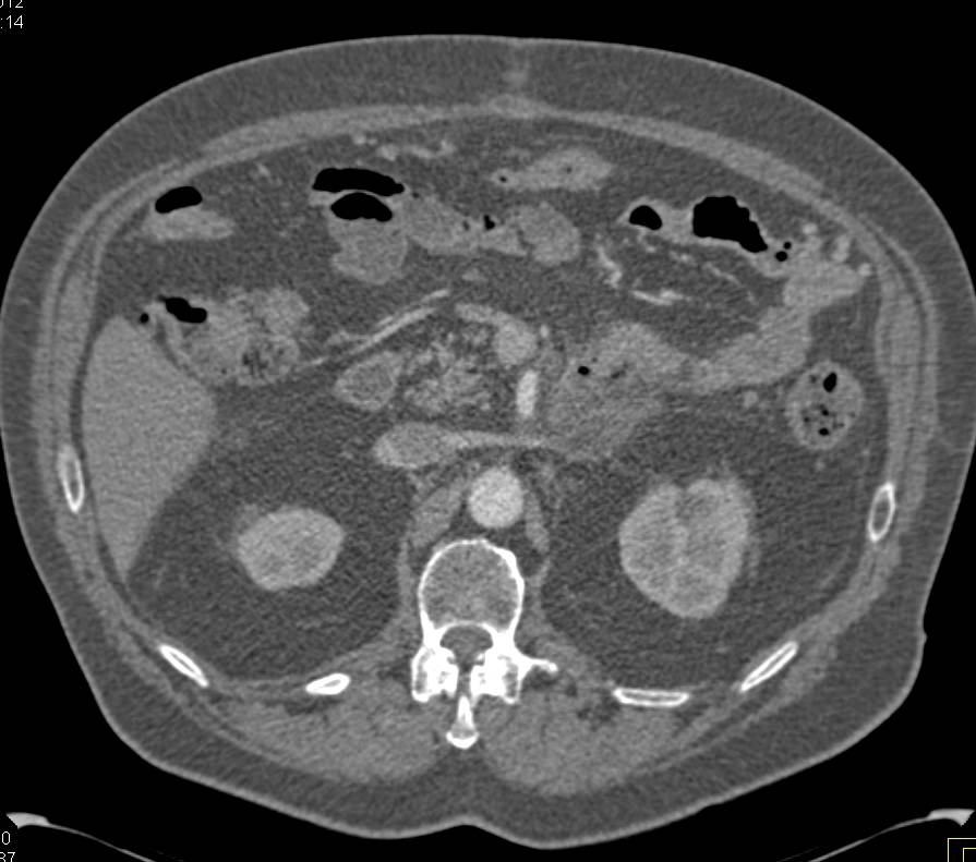 Recurrent Pancreatic Cancer - CTisus CT Scan