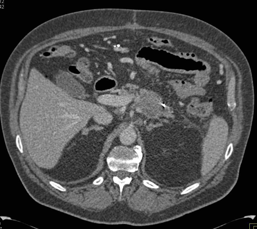 Carcinoma of Tail of the Pancreas - CTisus CT Scan