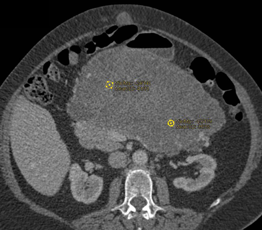 Serous Cystadenoma of the Pancreas - CTisus CT Scan