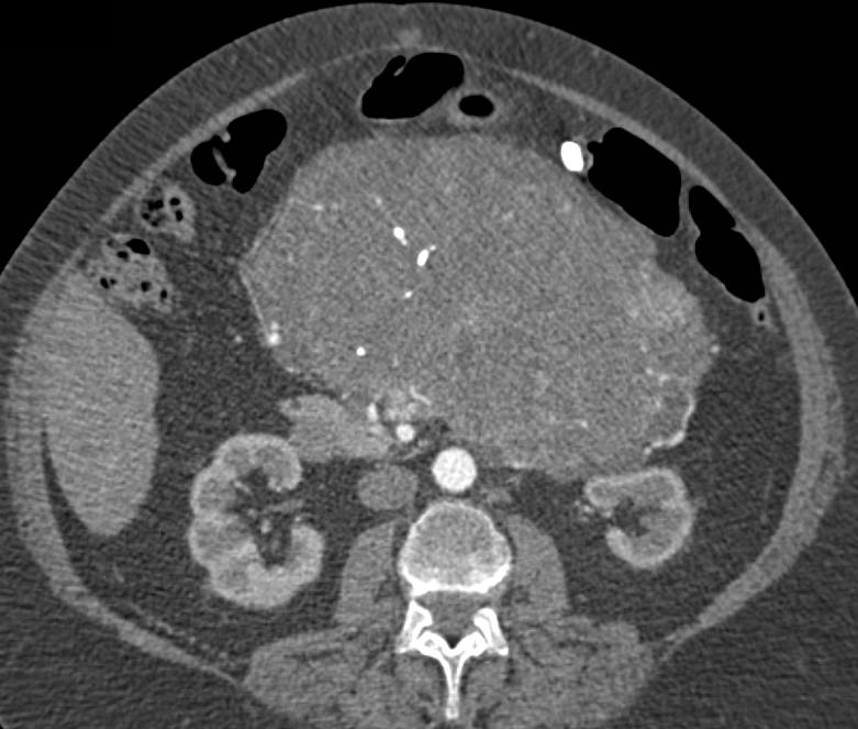 Serous Cystadenoma of the Pancreas with Vascular Map - CTisus CT Scan