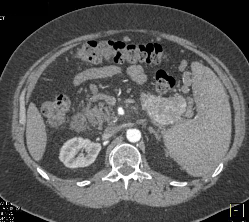 Neuroendocrine Tumor Tail of Pancreas with Venous Extension - CTisus CT Scan