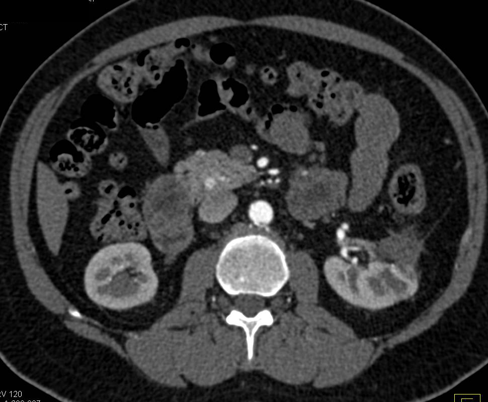 5mm Vascular Metastases from Renal Cell Carcinoma to the Head of the Pancreas - CTisus CT Scan