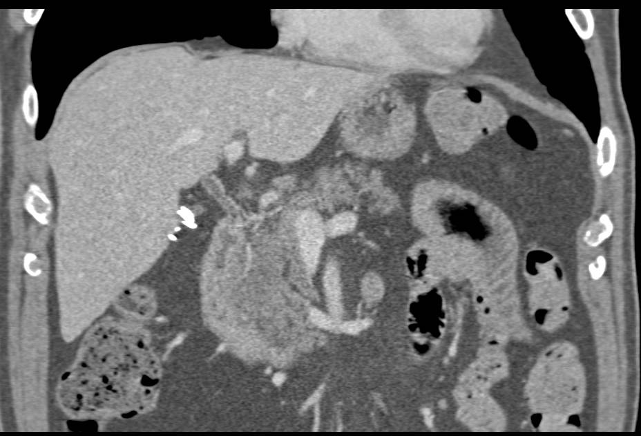Fatty Infiltration of the Head of the Pancreas with Normal Portal Vein - CTisus CT Scan