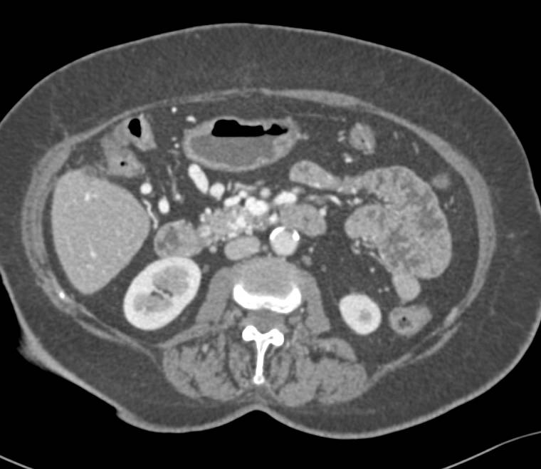 Collaterals Near Head of the Pancreas due to Celiac Stenosis - CTisus CT Scan