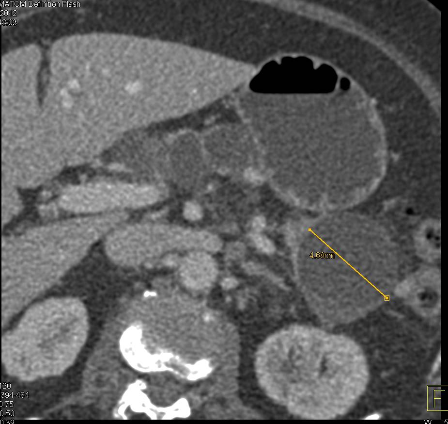 Multiple Intraductal Papillary Mucinous Neoplasms (IPMNs) with High Grade Dysplasia - CTisus CT Scan
