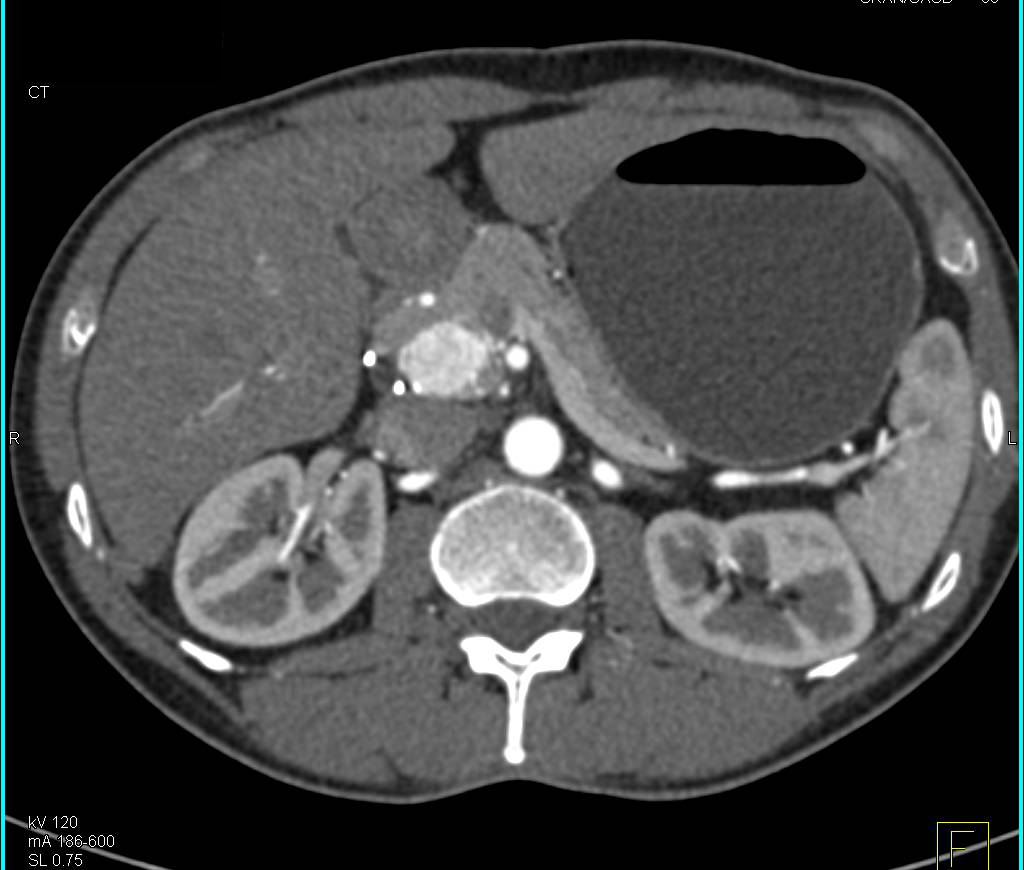 Neuroendocrine Tumor in Head of Pancreas - CTisus CT Scan