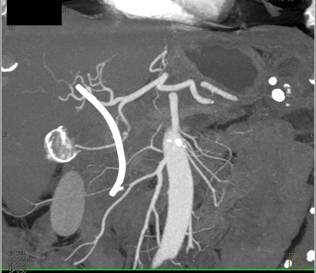 Stent in Common Bile Duct (CBD) with Pancreatic Cancer Invading the Portal Vein - CTisus CT Scan