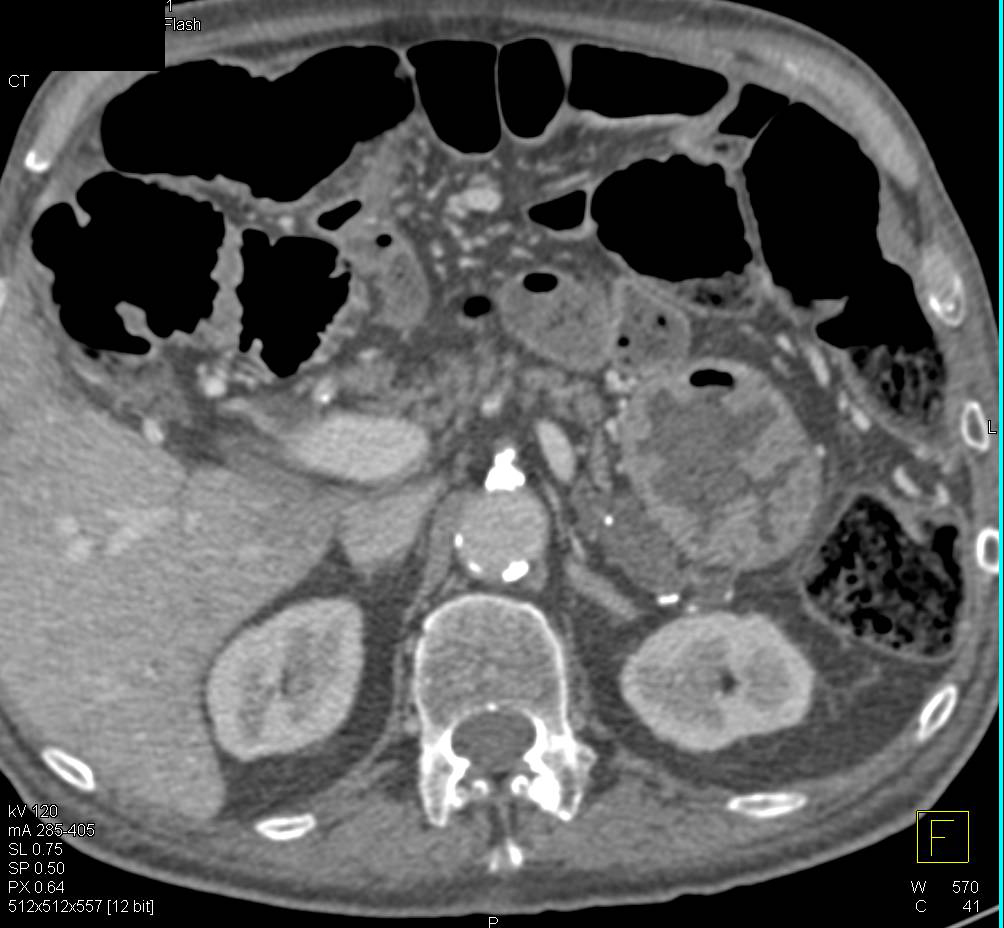 Chronic Pancreatitis - CTisus CT Scan