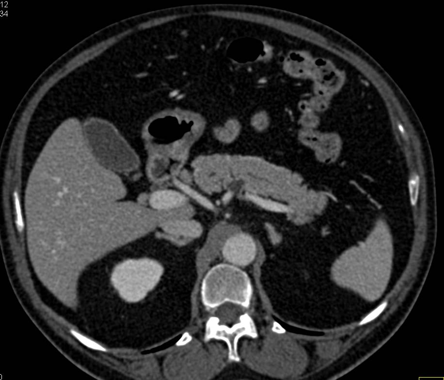 1cm Intraductal Papillary Mucinous Neoplasm (IPMN) - CTisus CT Scan