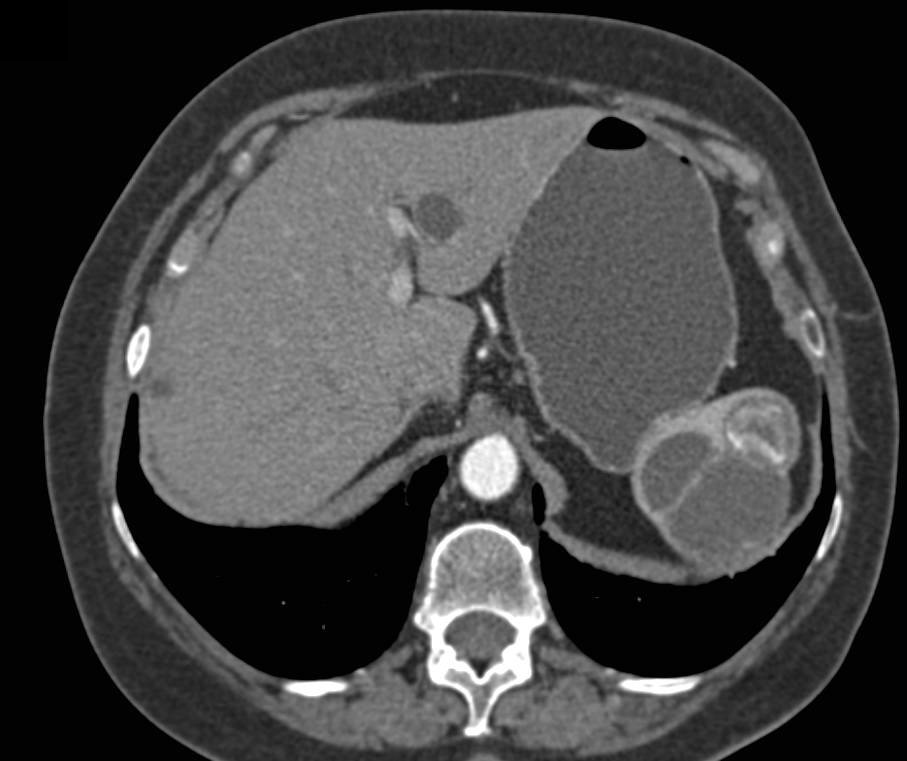 Cystic Neuroendocrine Tumor in Head of the Pancreas - CTisus CT Scan