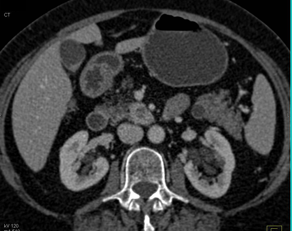 Pancreatic Cancer in Head of Pancreas and Multiple Intraductal Papillary Mucinous Neoplasms (IPMNs) - CTisus CT Scan