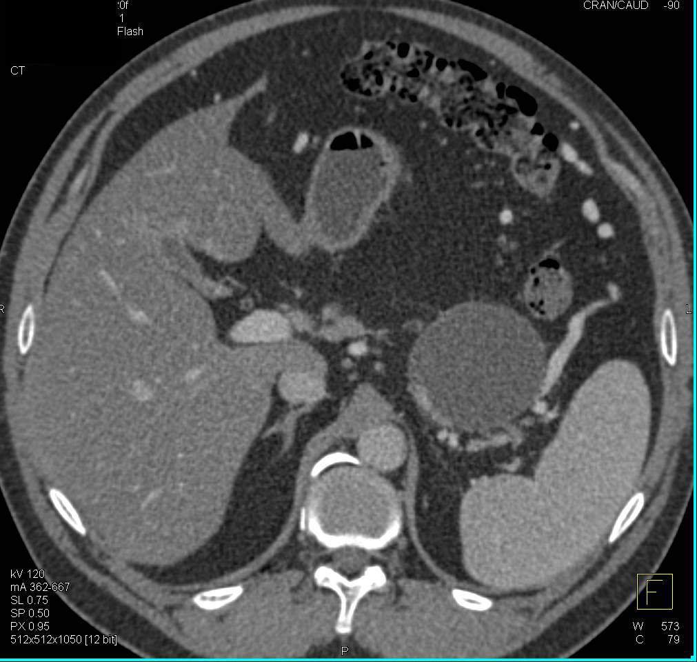 Lymphoepithelial Cyst of the Pancreas - CTisus CT Scan