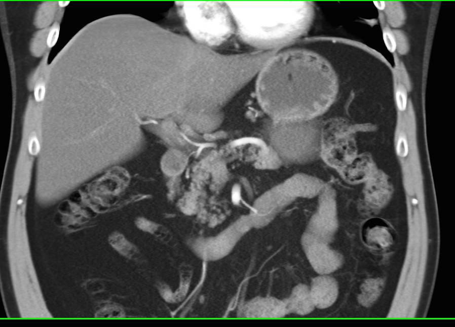 Mucinous Cystic Neoplasm (MCN) Tail of Pancreas - CTisus CT Scan