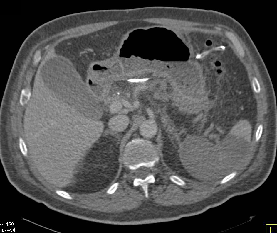 Post Whipple Procedure with Large Splenic Infarct - CTisus CT Scan