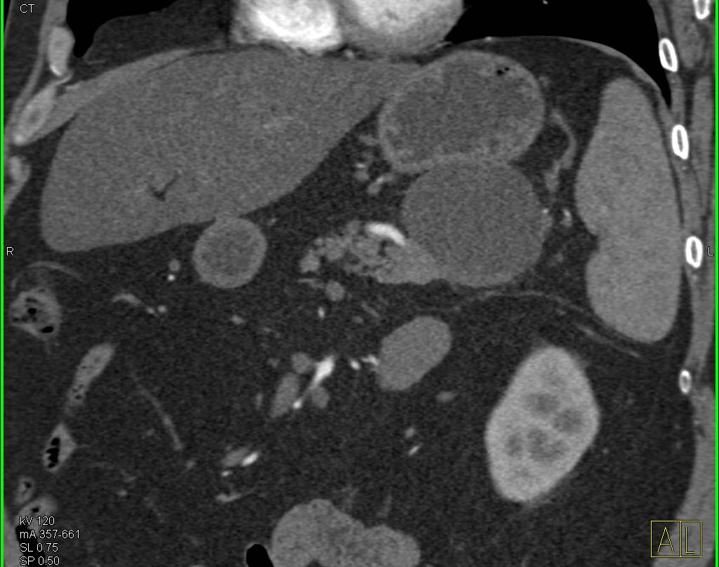 Lymphoepithelial Cyst of the Tail of the Pancreas - CTisus CT Scan