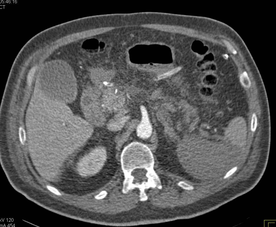 Splenic Infarct s/p Whipple Procedure - CTisus CT Scan