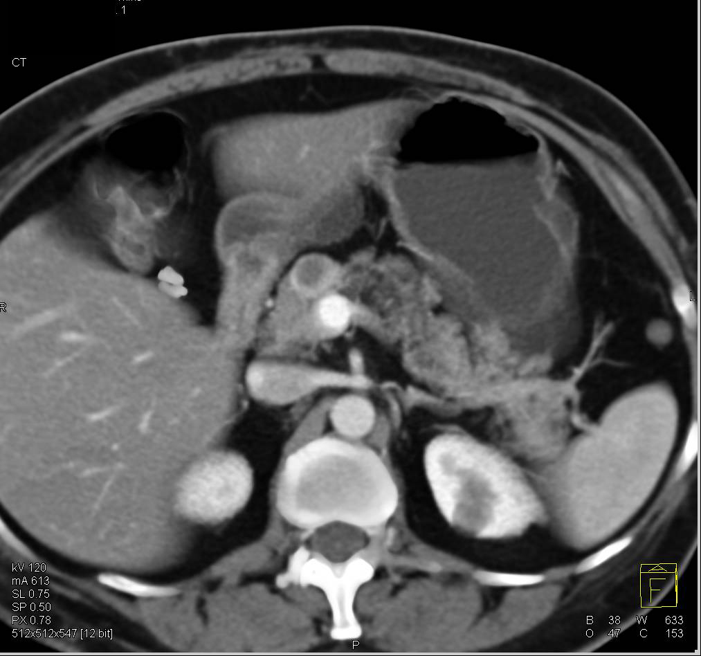 Neuroendocrine Tumor in Head of Pancreas - CTisus CT Scan