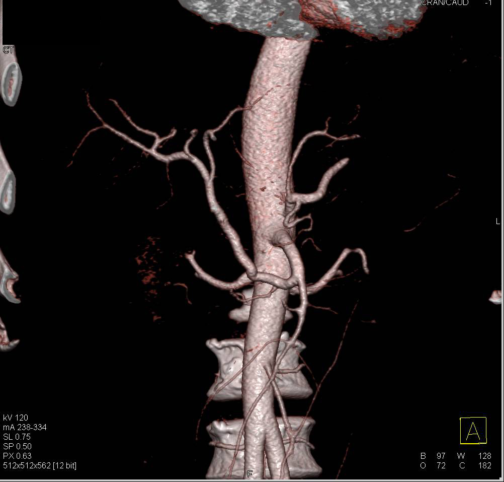 Hepatic Artery Arises off the Superior Mesenteric Artery (SMA) and is Encased by Pancreatic Cancer - CTisus CT Scan