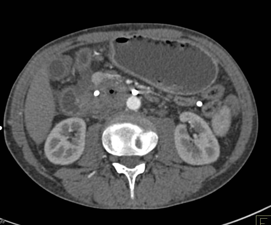 Pancreatic Adenocarcinoma Invades the Portal Vein and Superior Mesenteric Vein (SMV) with Extensive Collaterals - CTisus CT Scan