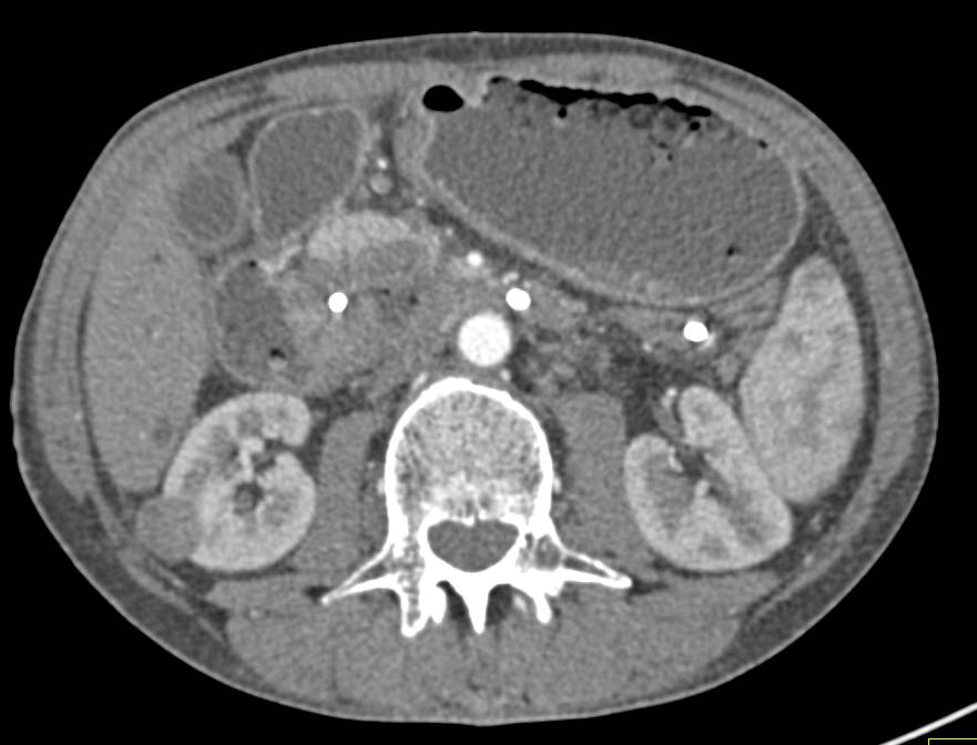 Duodenal Carcinoma Simulates a Pancreatic Cancer - CTisus CT Scan