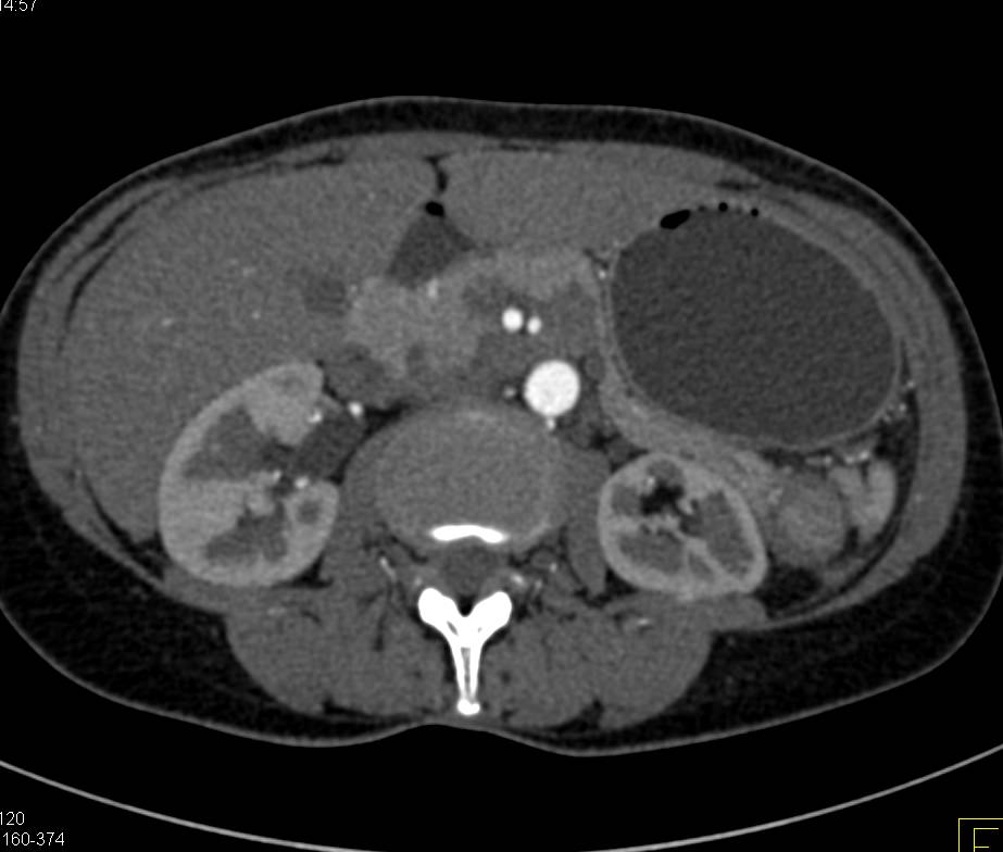 Mass in Tail of Pancreas was Castleman Disease - CTisus CT Scan