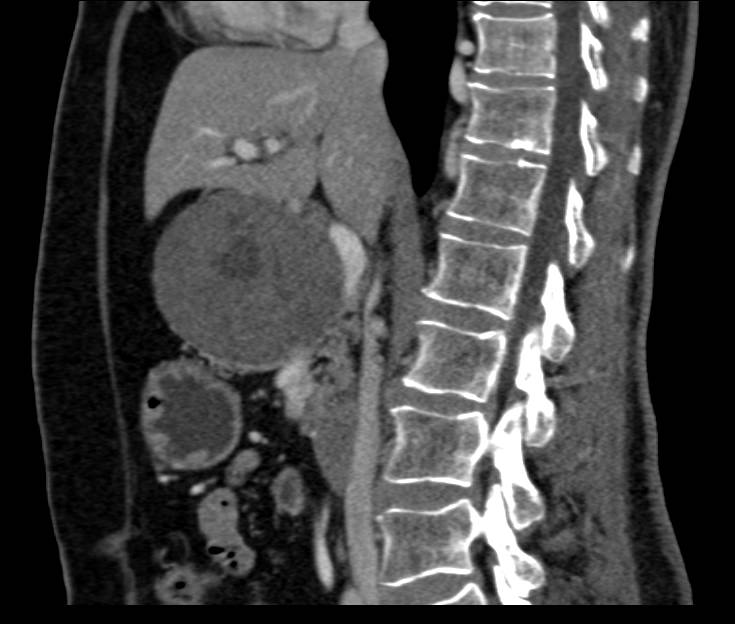 SPEN Tumor in Head of Pancreas - CTisus CT Scan