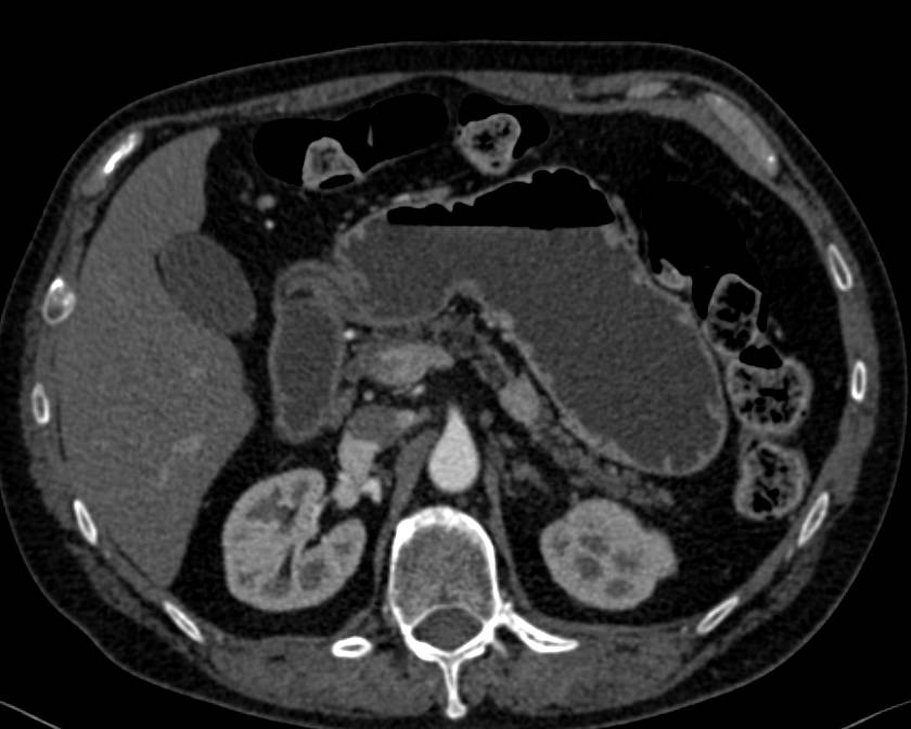 Neuroendocrine Tumor in the Body of the Pancreas - CTisus CT Scan