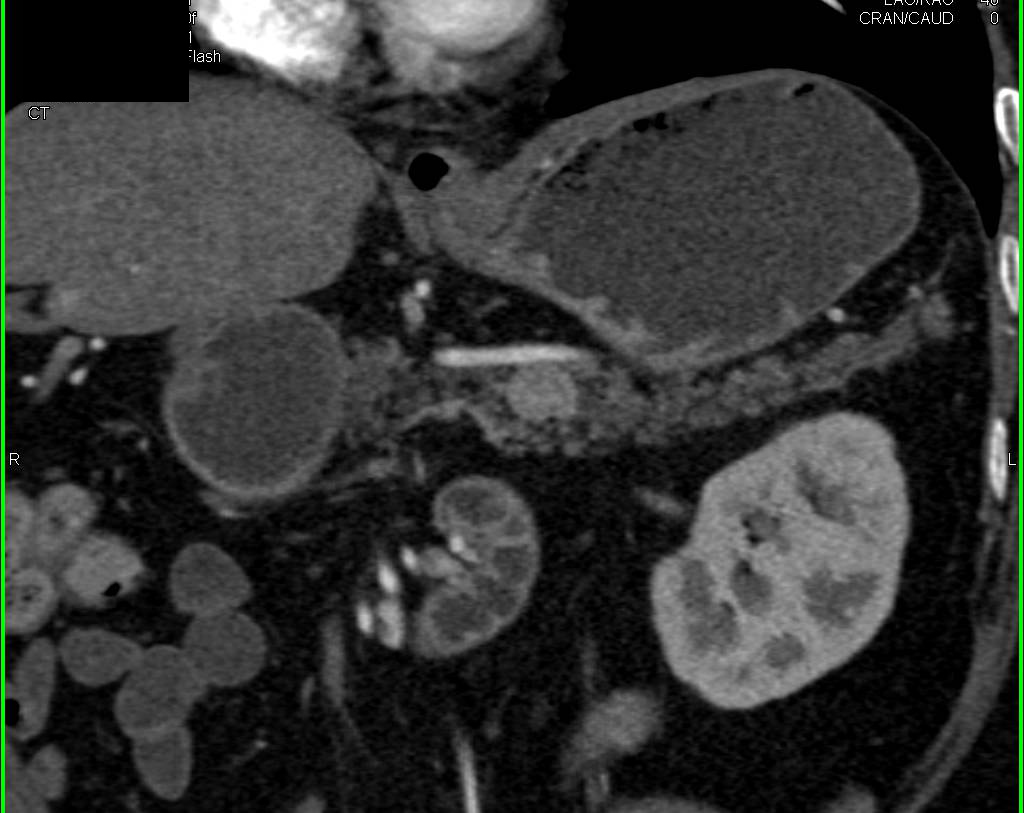 Pancreatic Neuroendocrine Tumor (PNET) Pancreas was an Insulinoma - CTisus CT Scan