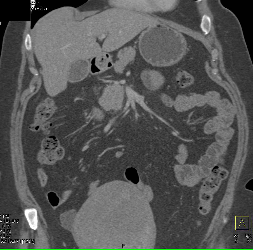 Neuroendocrine Tumor in Head of Pancreas - CTisus CT Scan