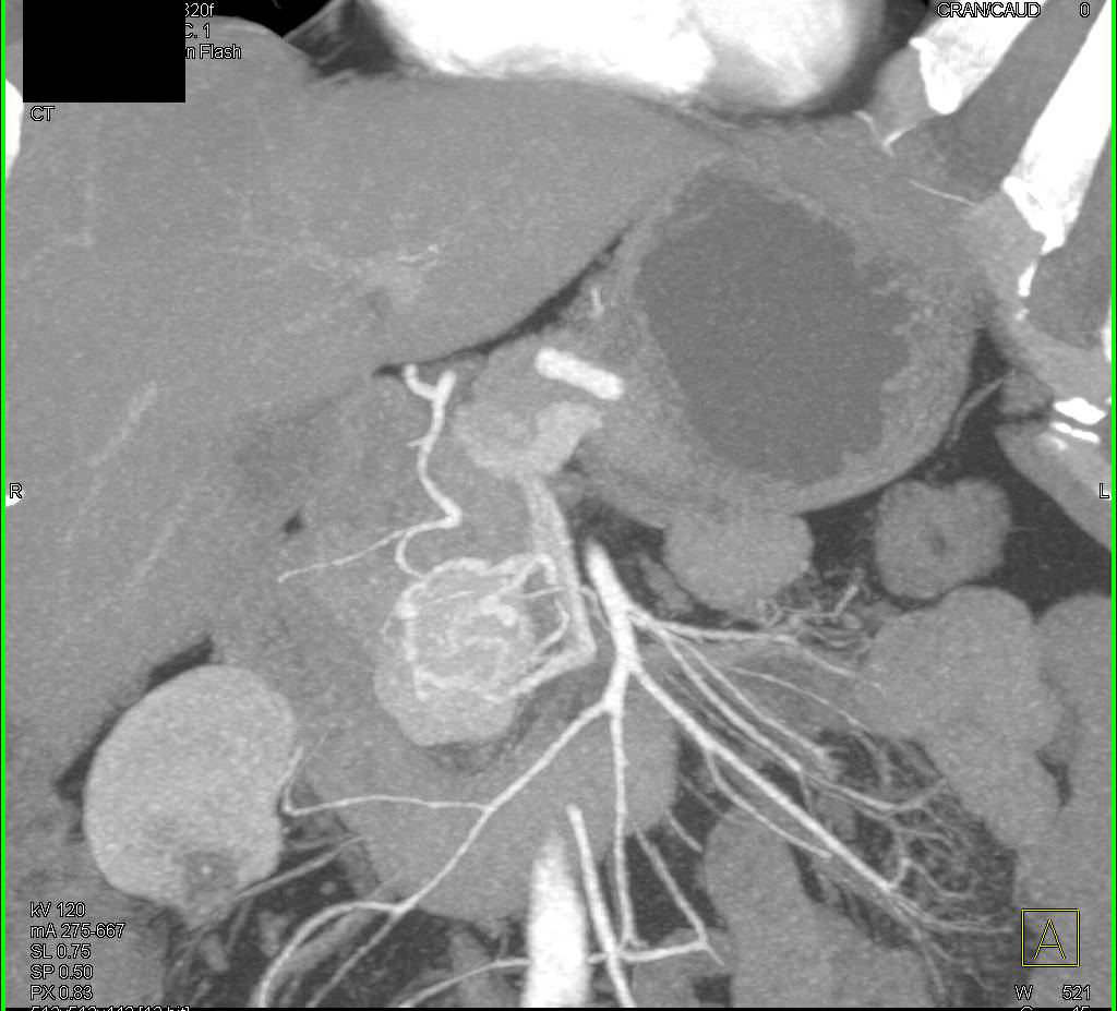 Neuroendocrine Tumor of the Pancreas - CTisus CT Scan