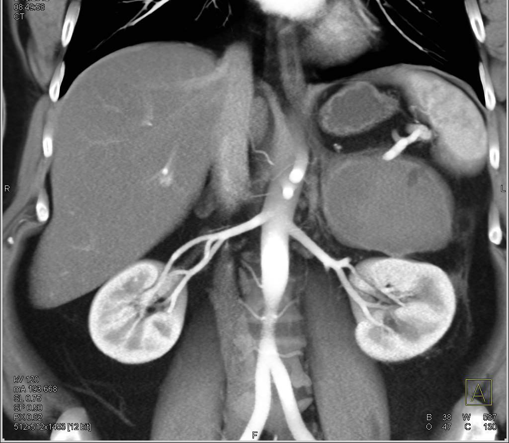 Pseudocyst of the Pancreas - CTisus CT Scan