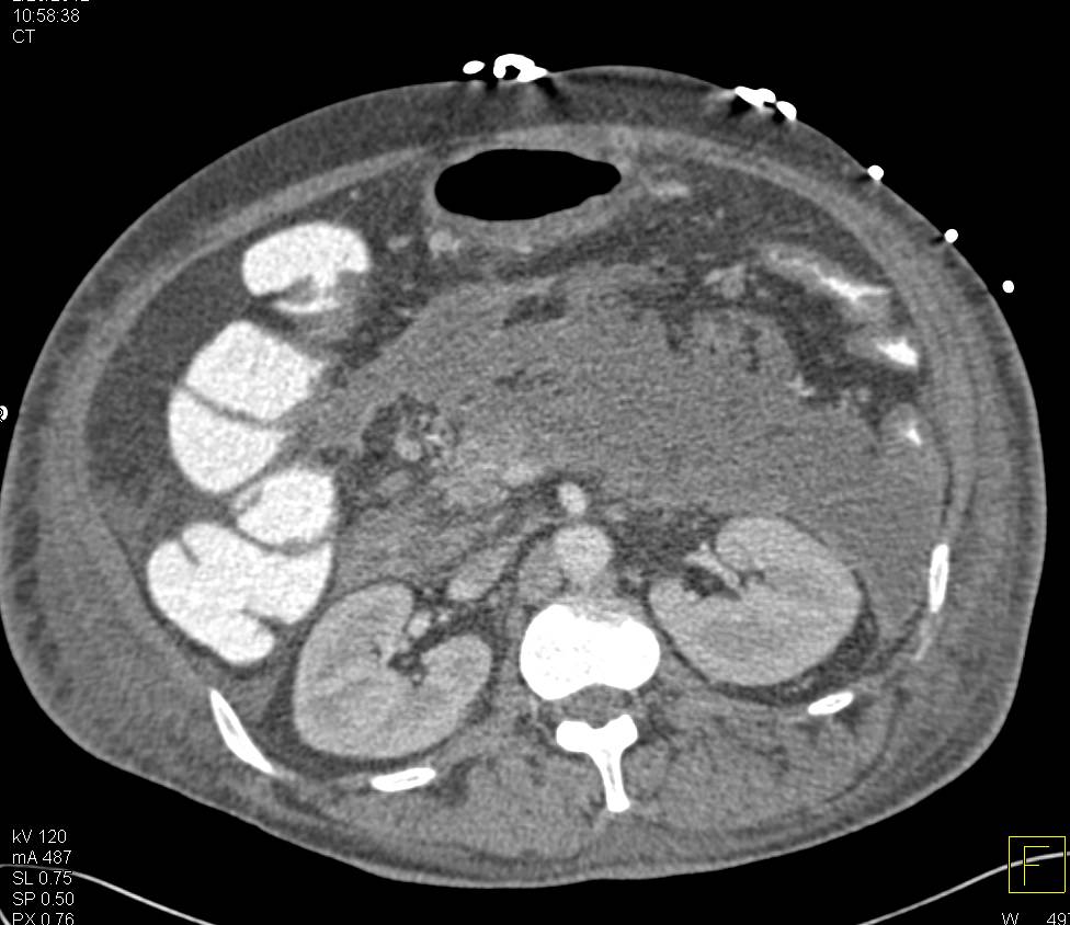 Pancreatitis with Pancreatic Necrosis Well Defined on Coronal Views - CTisus CT Scan