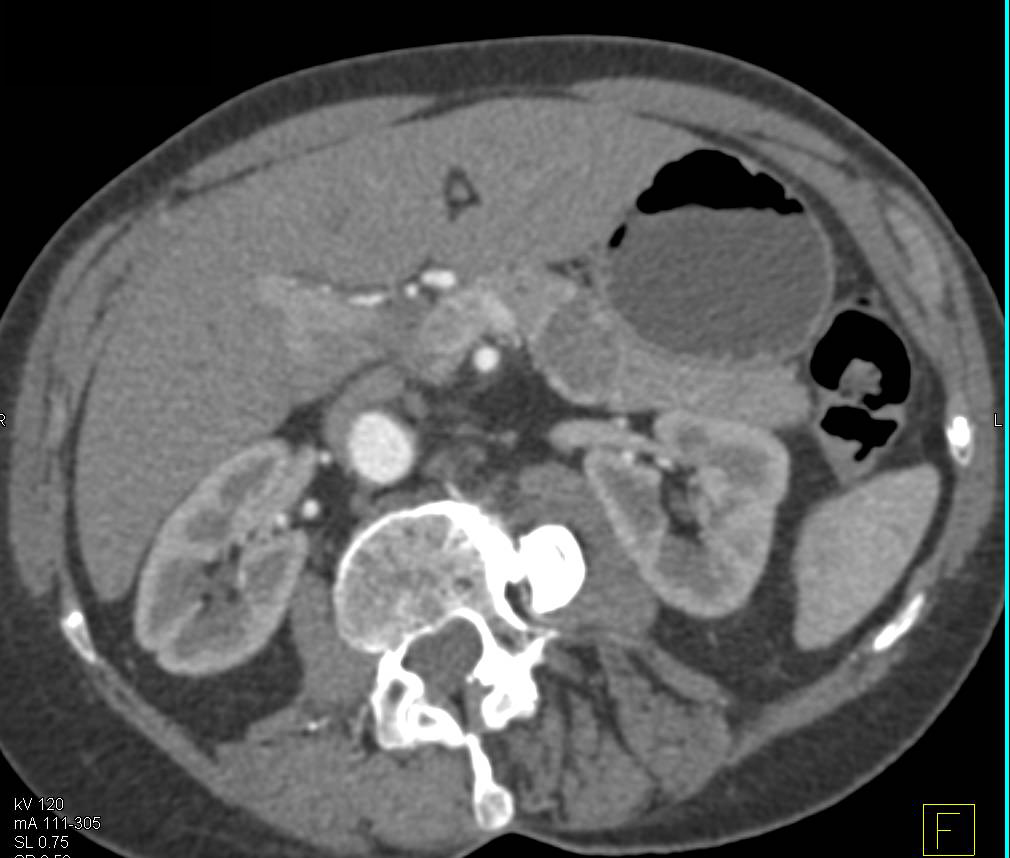 Pancreatic Cancer with Splenic Vein Occlusion - CTisus CT Scan