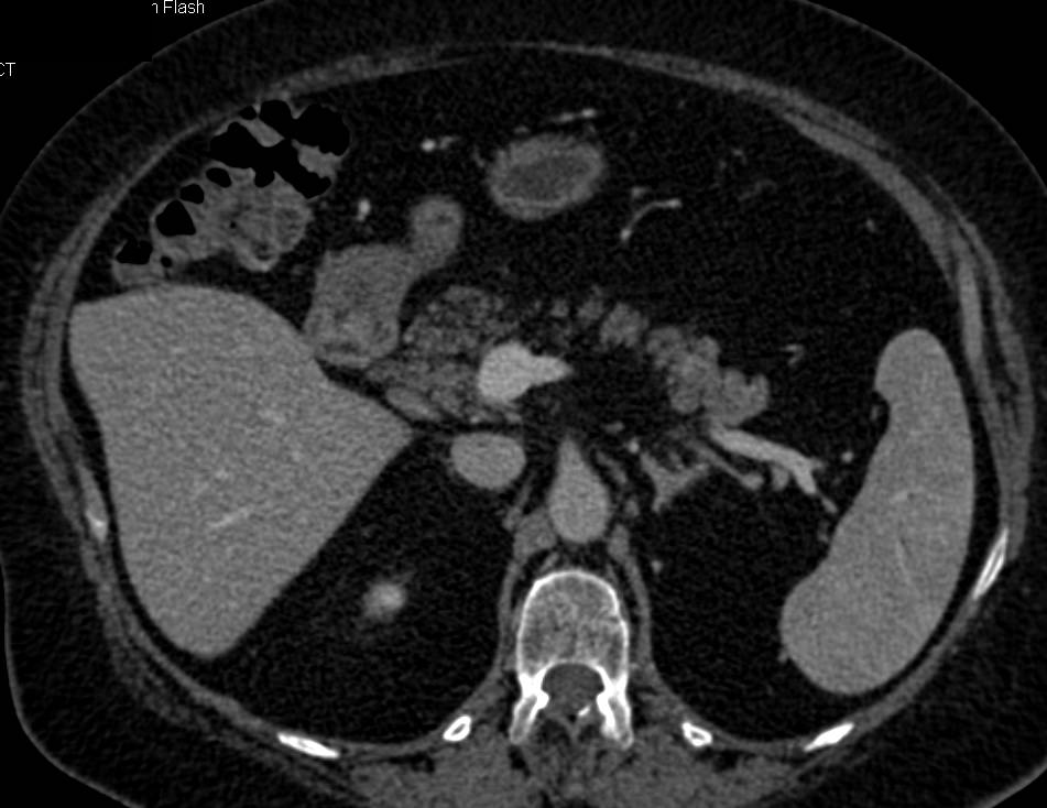 Fatty Infiltration of the Head of the Pancreas with Normal Portal Vein - CTisus CT Scan