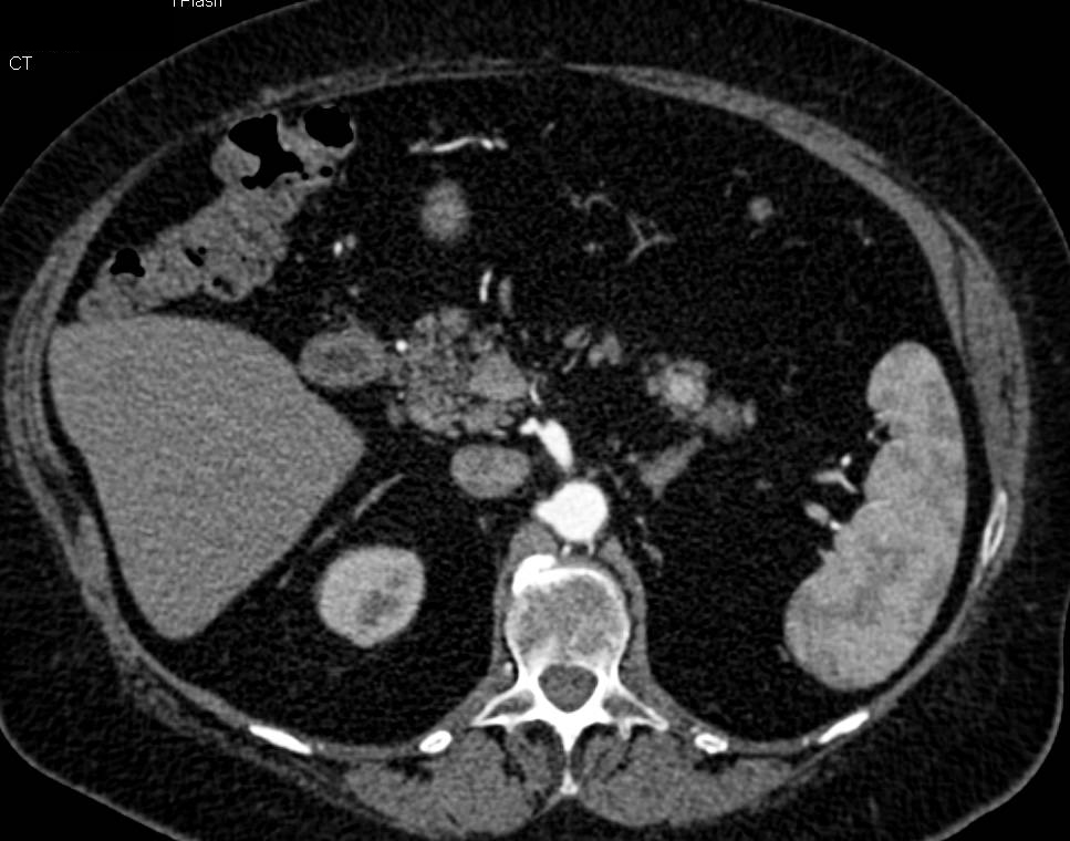 Neuroendocrine Tumor Tail of the Pancreas - CTisus CT Scan