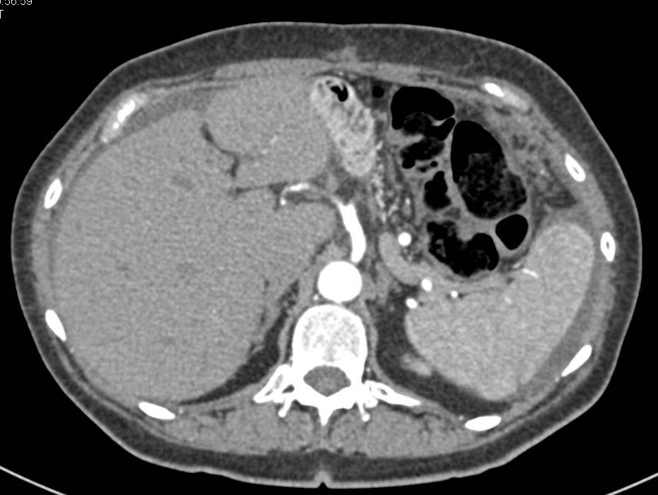 Carcinomatosis as Recurrence Pattern in Pancreatic Adenocarcinoma - CTisus CT Scan