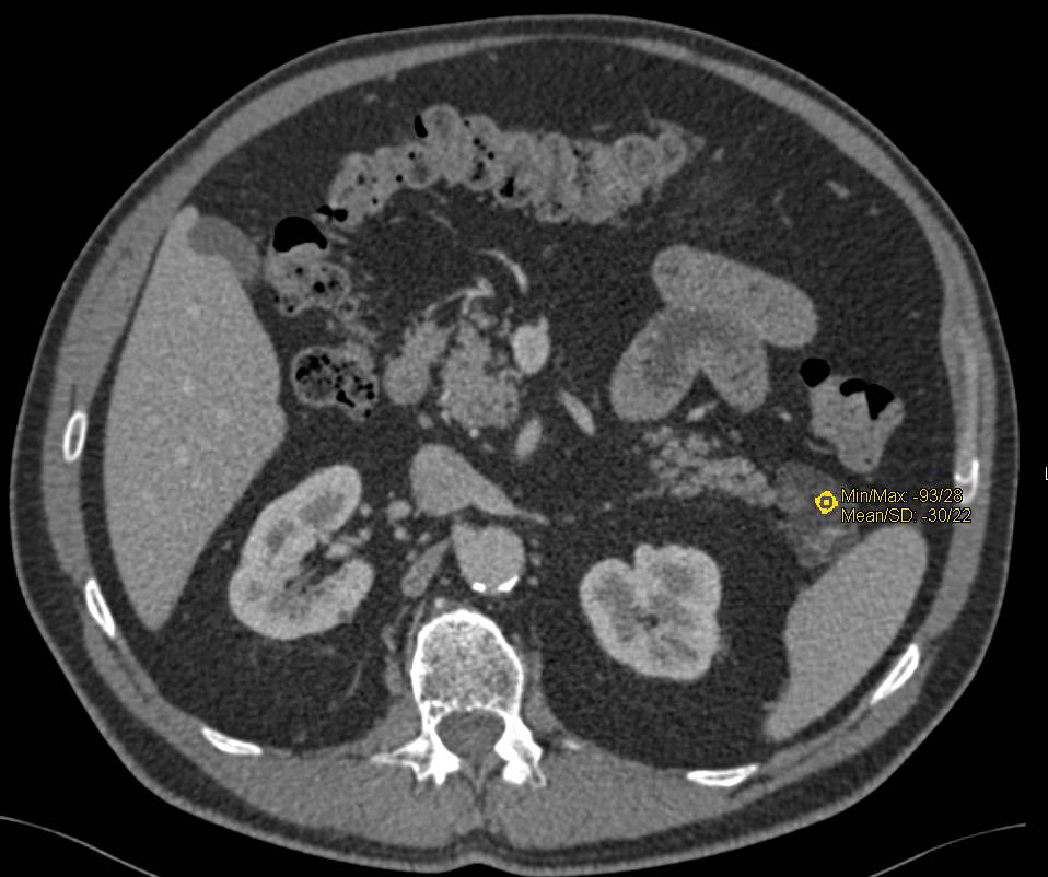 Lymphoepithelial Cyst of the Pancreas - CTisus CT Scan